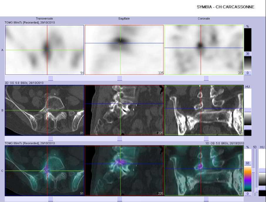 Fracture de l'apophyse transverse droite de L5
