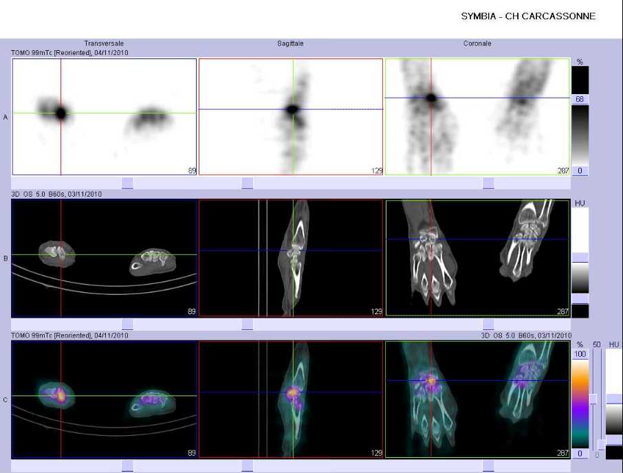 Fracture occulte du scapho&iuml;de carpien droit