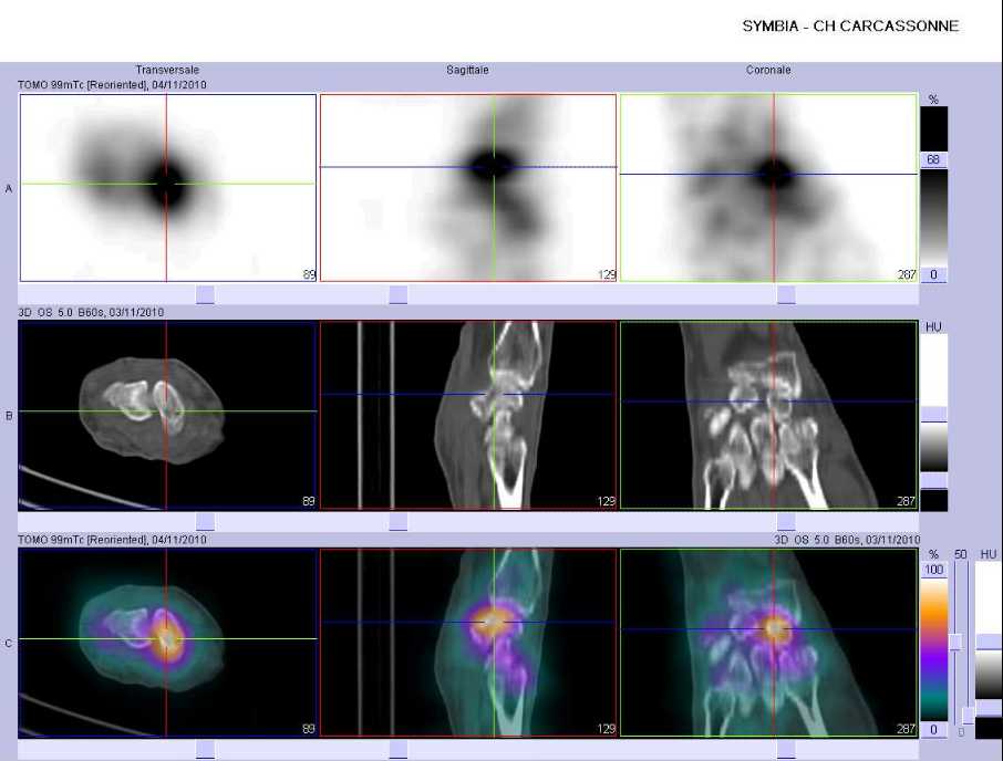 Fracture occulte du scapho&iuml;de carpien droit