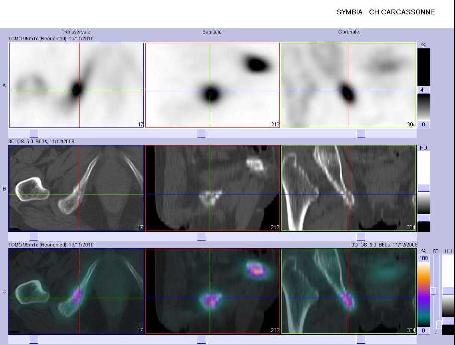 Fracture de la branche ischio-pubienne droite