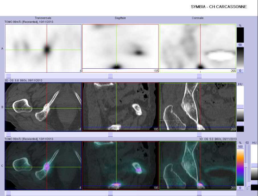 Fracture par insuffisance osseuse de la branche ischio-pubienne droite