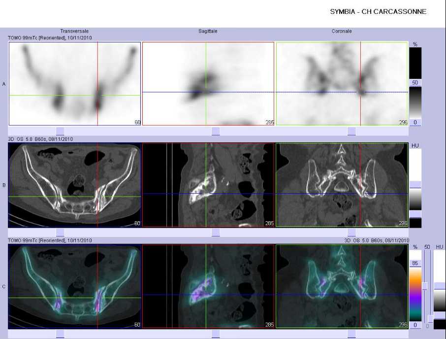 Fractures par insuffisance osseuse des ailerons sacr&eacute;s