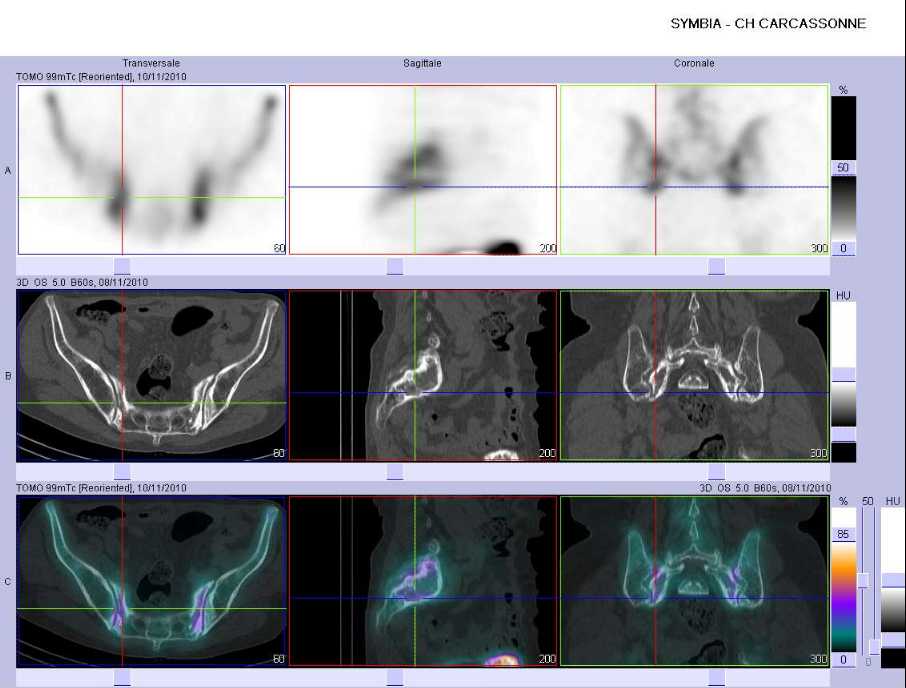 Fractures par insuffisance osseuse des ailerons sacr&eacute;s