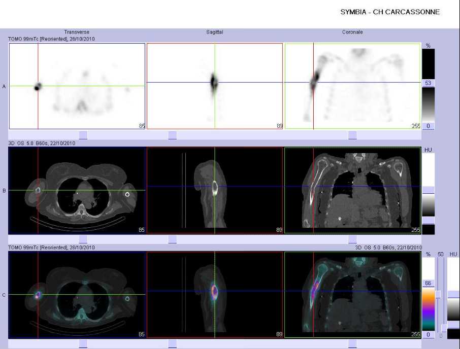 Fracture de l'hum&eacute;rus droit sur m&eacute;tastase osseuse