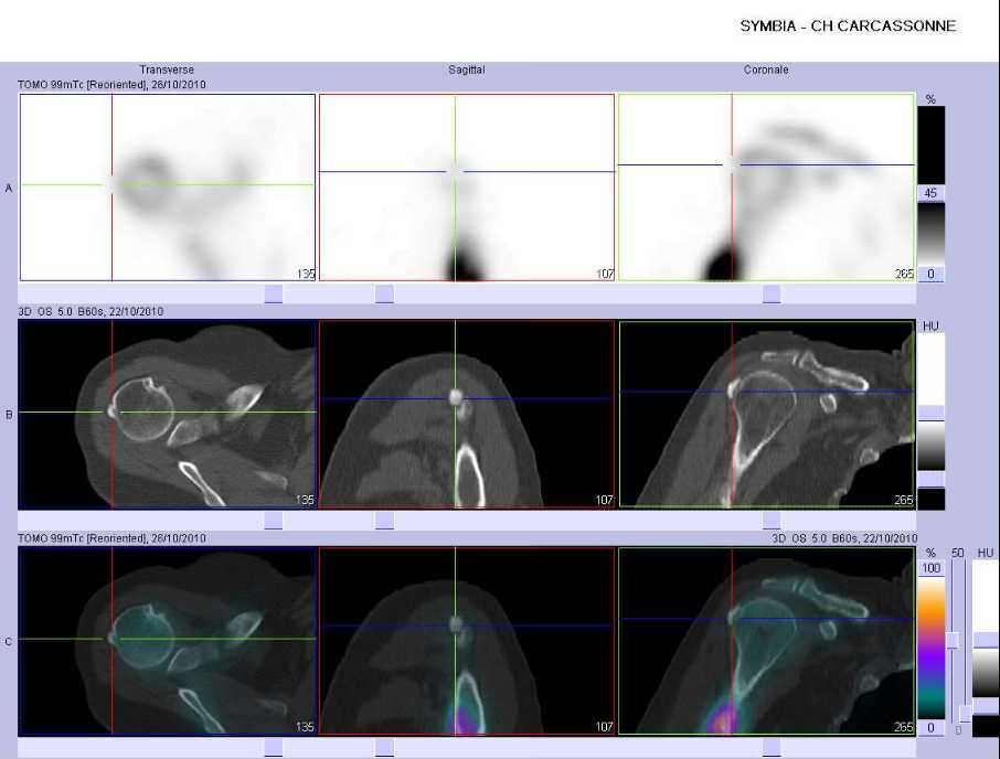 Calcifications au contact de la t&ecirc;te hum&eacute;rale droite