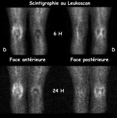 Leukoscan