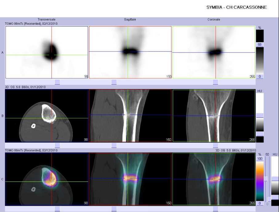 Fracture de fatigue du tibia
