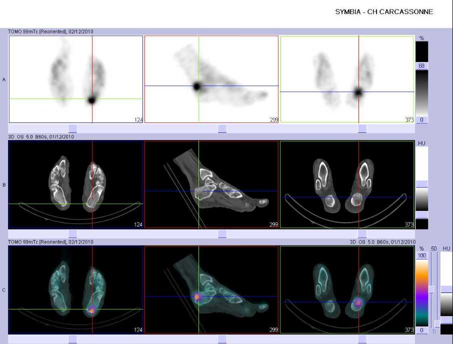 Tendinopathie d'insertion du tendon d'achille gauche