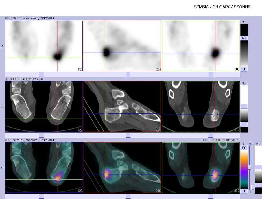 Tendinopathie d'insertion du tendon d'achille gauche
