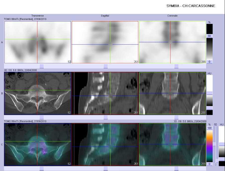 Arthrose L5/S1