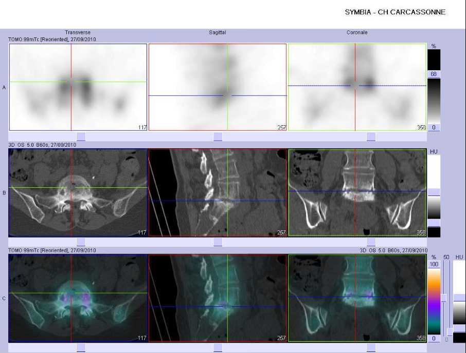 Spondylolisth&eacute;sis et discopathie arthrosique L5-S1