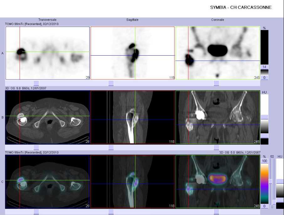 Calcifications p&eacute;ri-proth&eacute;tiques