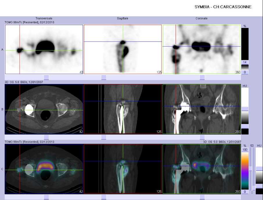 Calcifications p&eacute;ri-proth&eacute;tiques
