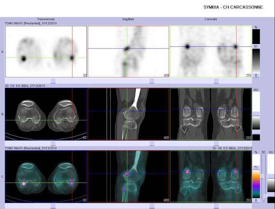 Tendinopathie du genou gauche sus e t r&eacute;trocondylienne m&eacute;diale et lat&eacute;rale 