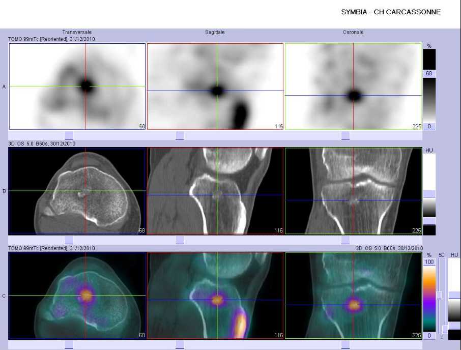 Enchondrome de l'&eacute;piphyse sup&eacute;rieure du tibia droit