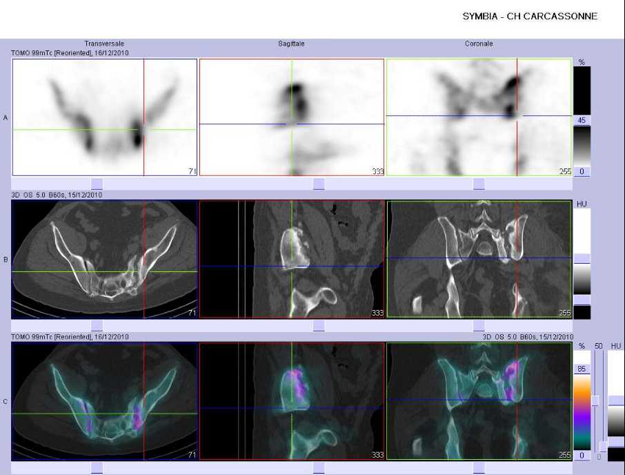 Ost&eacute;o-arthrite du sacrum et de l'aile iliaque