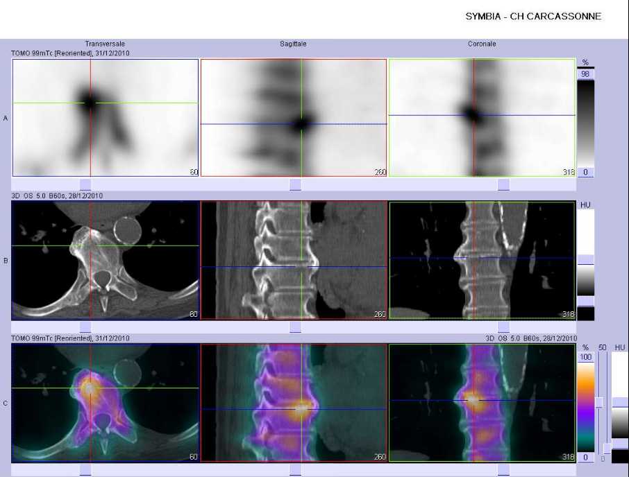 Arthrose rachidienne thoracique