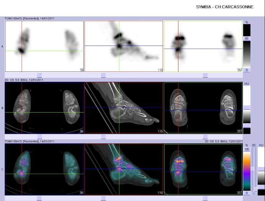 L&eacute;sion microtraumatique de la sous-talienne post&eacute;rieure droite