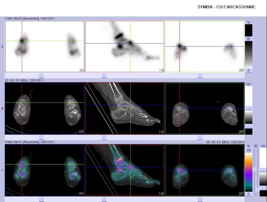 L&eacute;sion microtraumatique de la talo-naviculaire droite