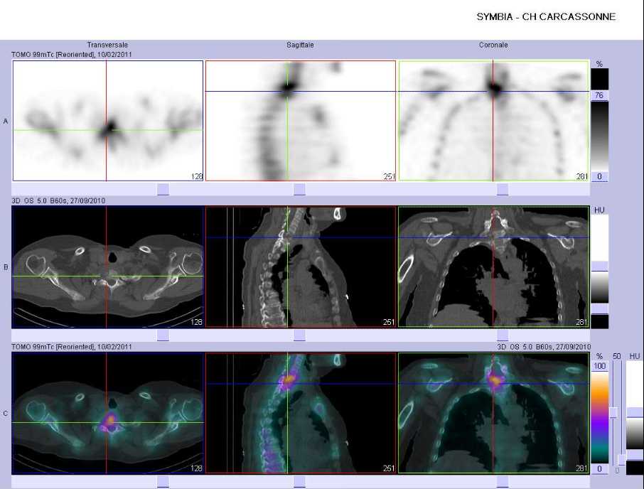 Ost&eacute;olyse du corps vert&eacute;bral de C7 en rapport avec un lymphome osseux