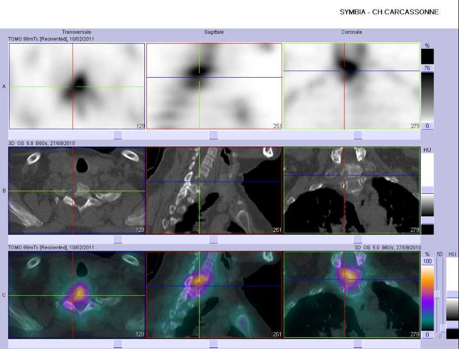 Ost&eacute;olyse du corps vert&eacute;bral de C7 en rapport avec un lymphome osseux