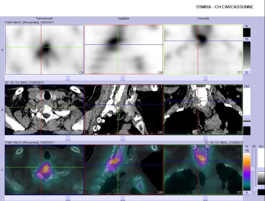 Envahissement lymphomateux de l'espace pr&eacute;-vert&eacute;bral