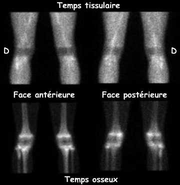 Genoux - Clich&eacute;s pr&eacute;coces et tardifs