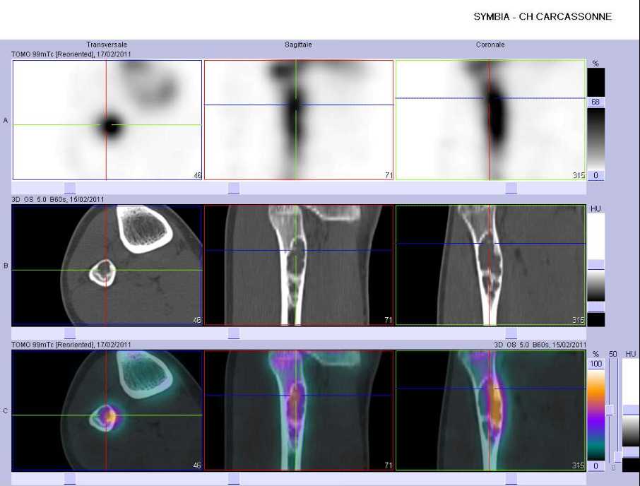 Fibrome non ossifiant du tiers sup&eacute;rieur de la fibula droite