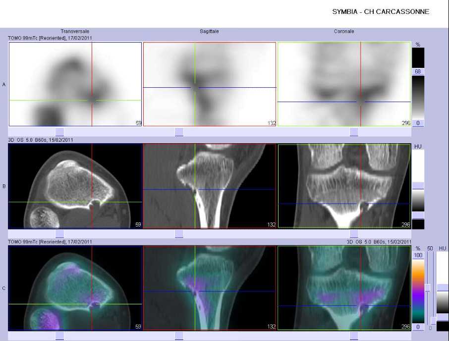 D&eacute;fect cortical fibreux de la m&eacute;taphyse sup&eacute;rieure du tibia droit