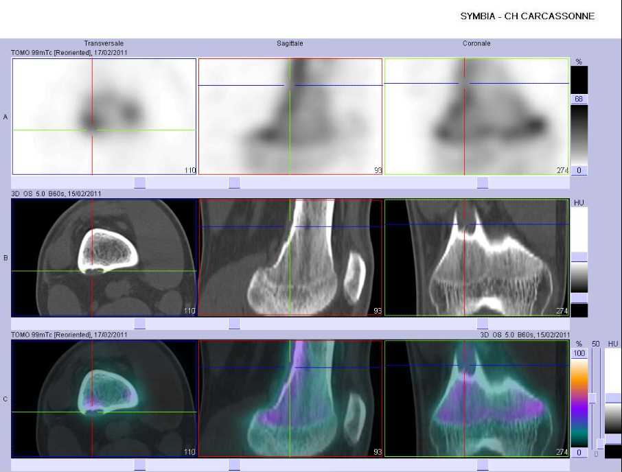 D&eacute;fect cortical fibreux de la m&eacute;taphyse inf&eacute;rieure du f&eacute;mur droit