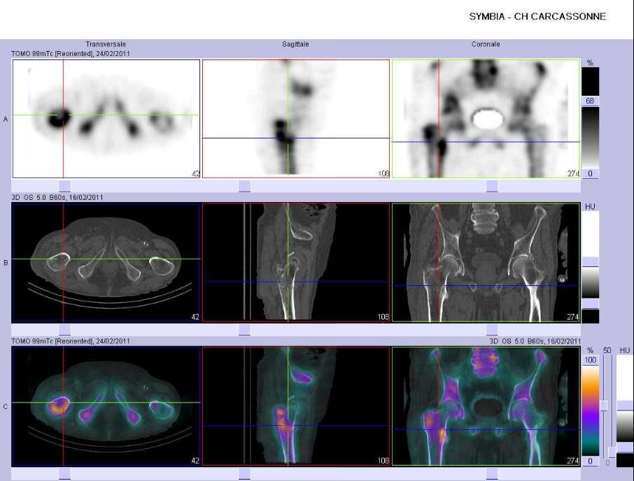 Fracture intertrochant&eacute;rienne du f&eacute;mur droit