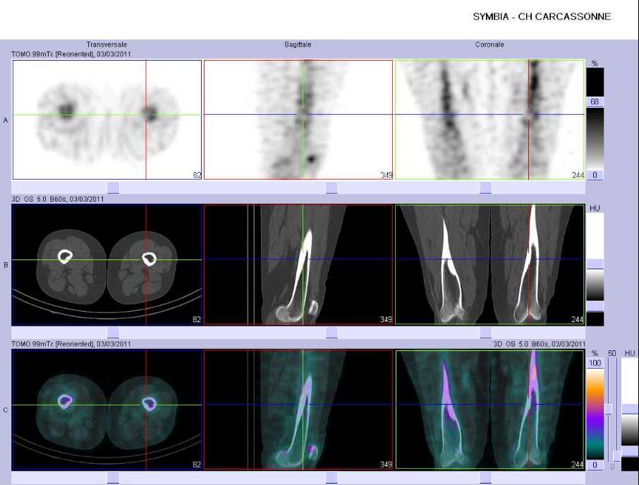 Cicatrice d'un fibrome non ossifiant f&eacute;moral gauche