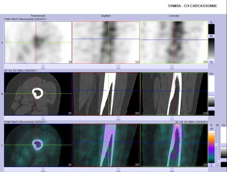 Cicatrice d'un fibrome non ossifiant f&eacute;moral gauche