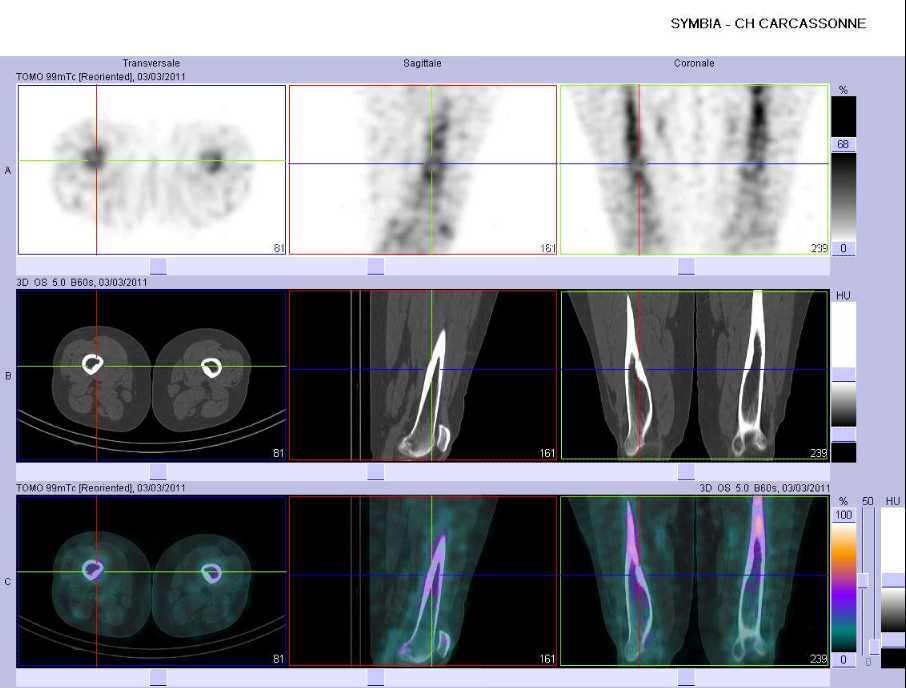 Cicatrice d'un fibrome non ossifiant f&eacute;moral droit