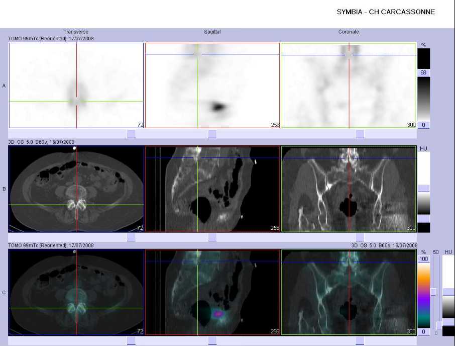 Arthrose des articulaires post&eacute;rieures de L5