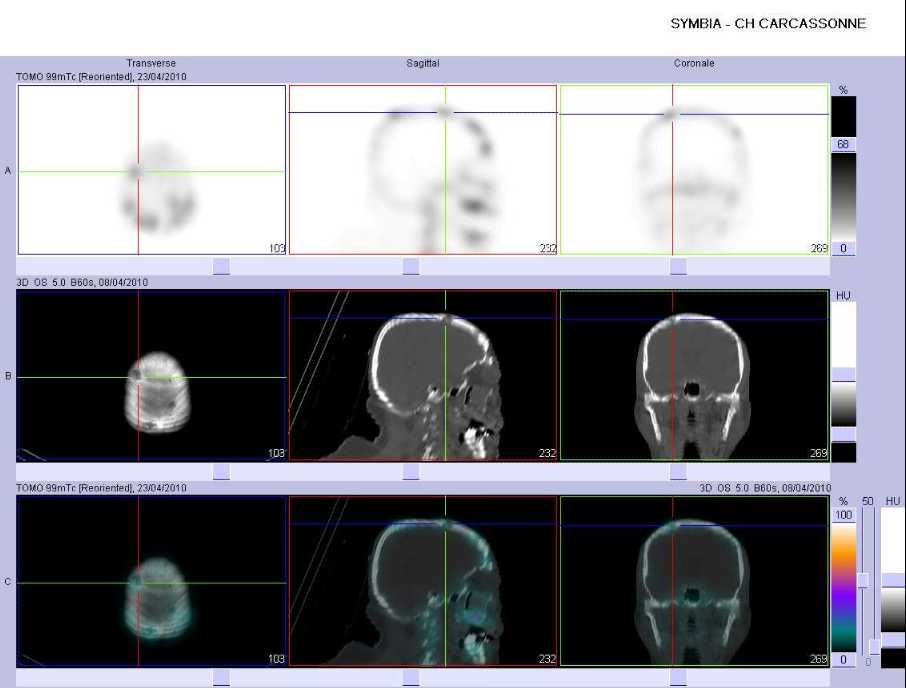 Multiples images d'ost&eacute;olyse du cr&acirc;ne