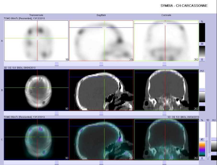 Multiples images d'ost&eacute;olyse du cr&acirc;ne