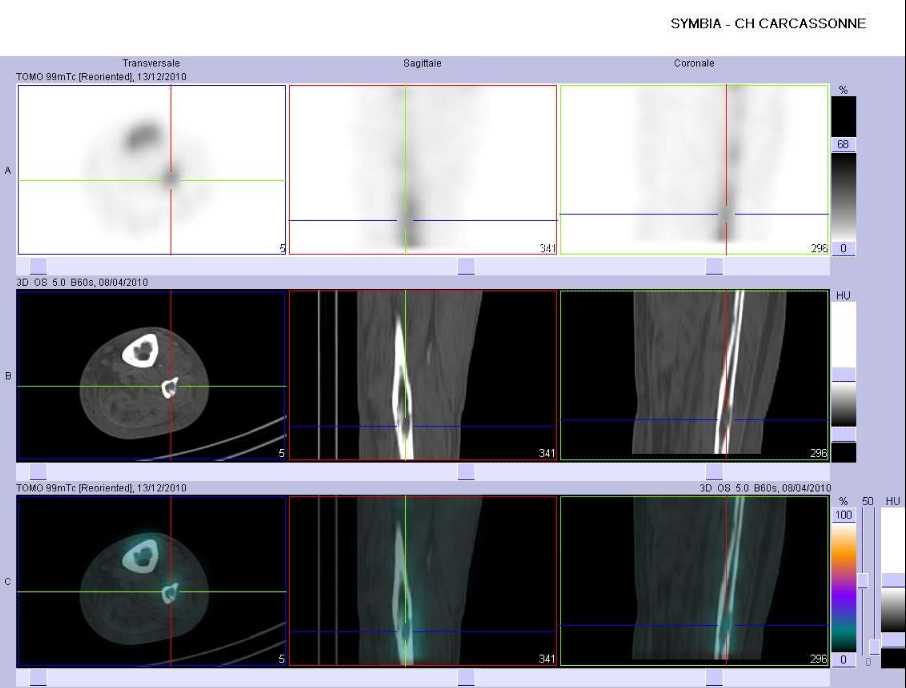 Multiples &eacute;rosions corticales du tibia et de la fibula du c&ocirc;t&eacute; gauche