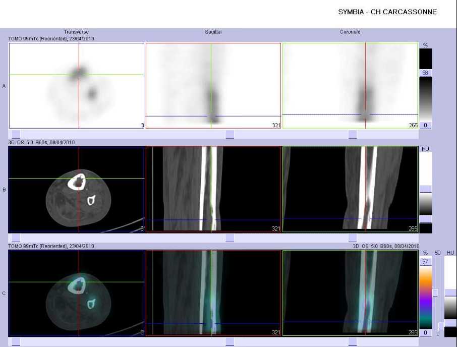 Multiples &eacute;rosions corticales du tibia et de la fibula du c&ocirc;t&eacute; gauche