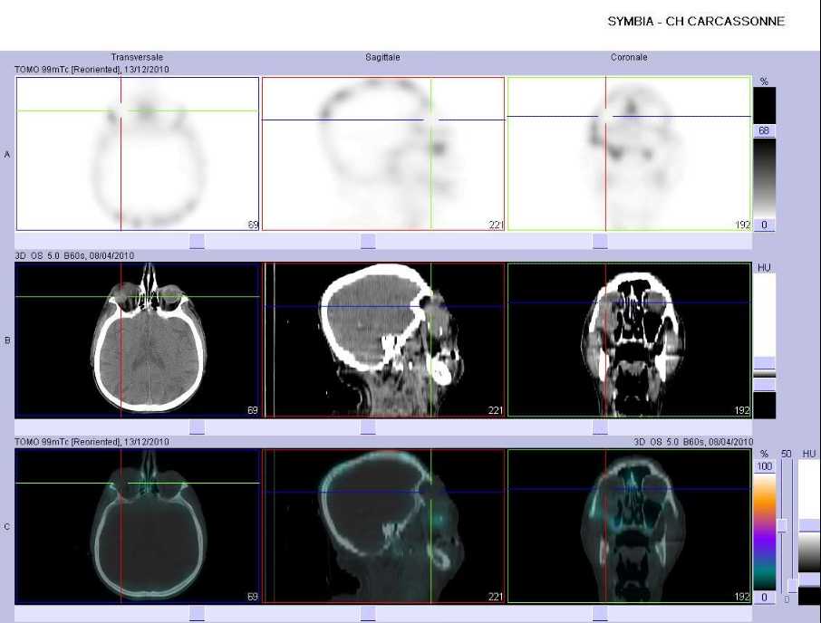 Masse tissulaire envahissant le sinus maxillaire droit et l'orbite droite et lysant l'os malaire