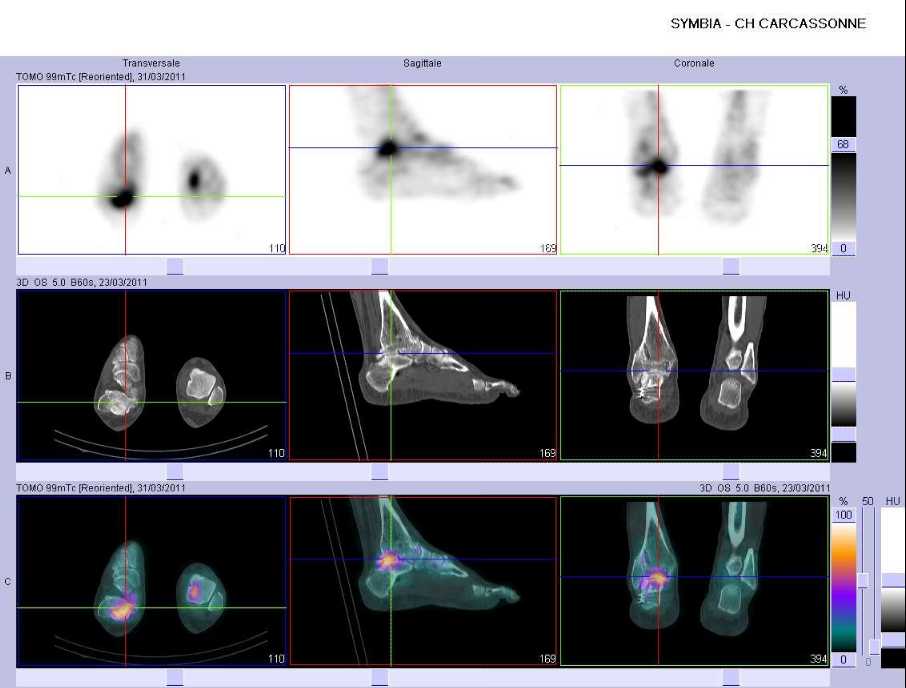 S&eacute;quelles de fracture de la cheville et du calcan&eacute;um du c&ocirc;t&eacute; droit