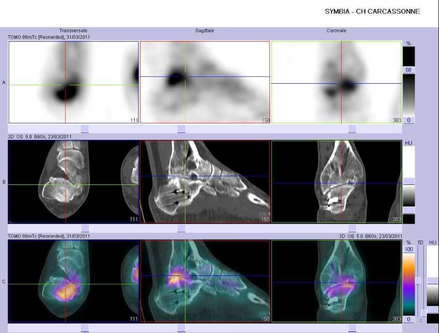 S&eacute;quelles de fracture de la cheville et du calcan&eacute;um du c&ocirc;t&eacute; droit