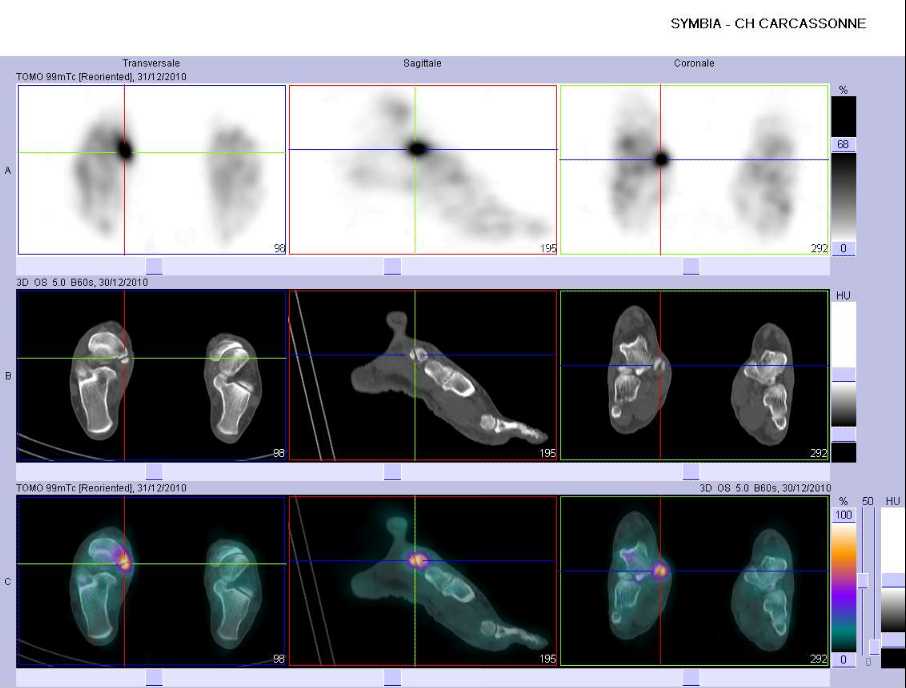 Tendinopathie d'insertion du tendon du tibial post&eacute;rieur droit