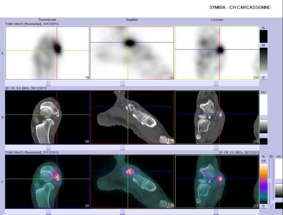 Tendinopathie d'insertion du tendon du tibial post&eacute;rieur droit