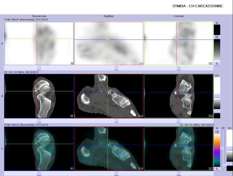Absence de tendinopathie d'insertion du c&ocirc;t&eacute; gauche
