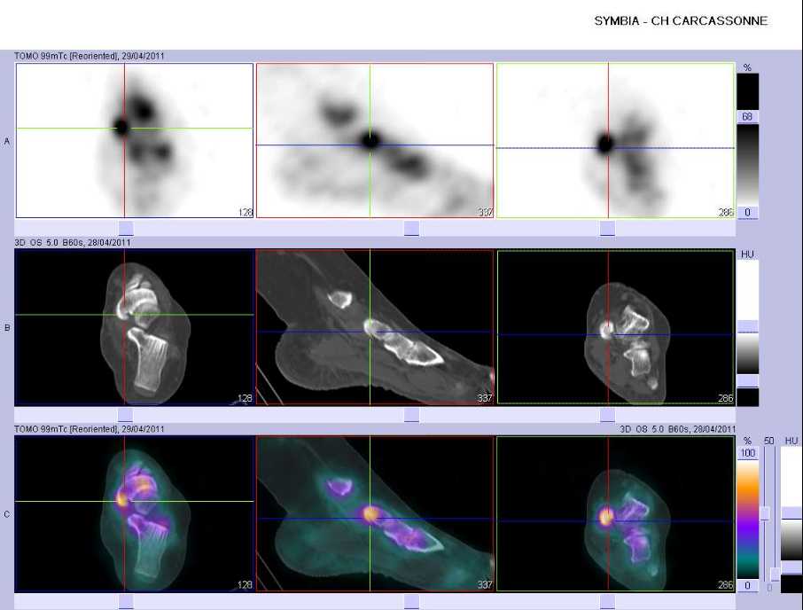 Tendinopathie du tendon du muscle tibial post&eacute;rieur gauche sur le tubercule m&eacute;dial du naviculaire