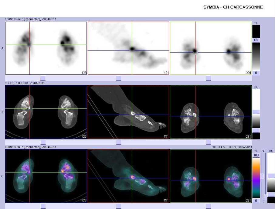 Tendinopathie du tendon du muscle tibial post&eacute;rieur droit sur le tubercule m&eacute;dial du naviculaire