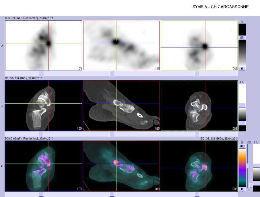 Tendinopathie du tendon du muscle tibial post&eacute;rieur droit sur le tubercule m&eacute;dial du naviculaire