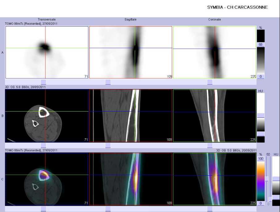 Fracture longitudinale du tibia droit