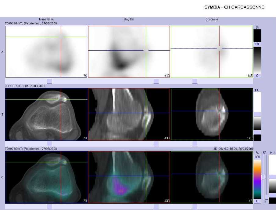 Patella bipartita